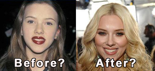 Chirurgie de star: Scarlett Johansson